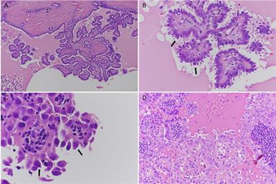 Clinical–Pathological Features and Treatment Outcome of Patients With Hobnail Variant Papillary Thyroid Carcinoma